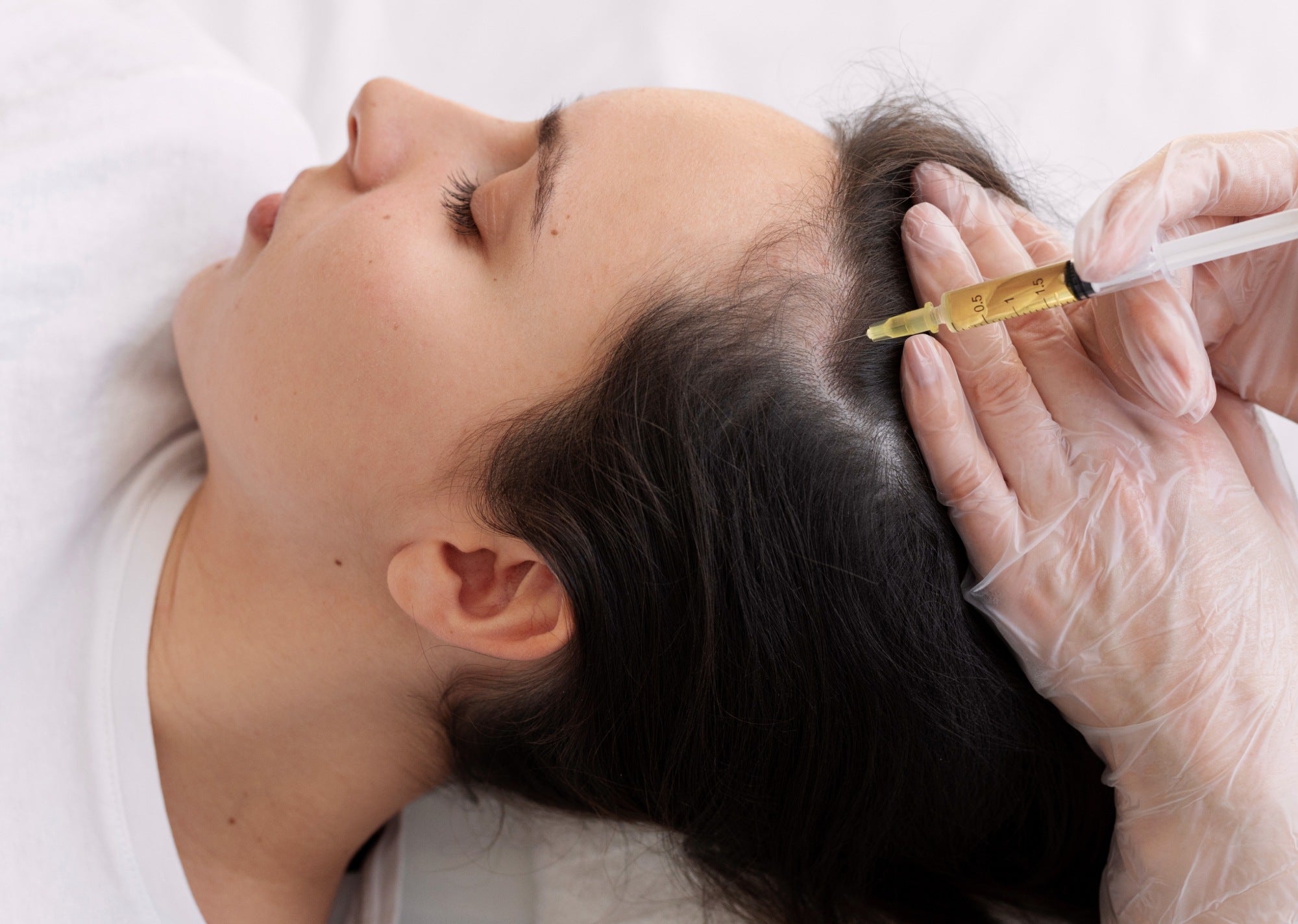 Mésothérapie Cheveux